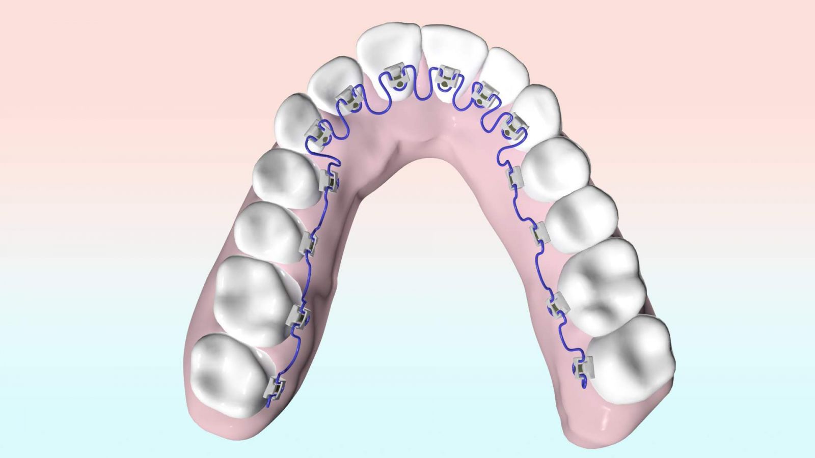 lingual braces